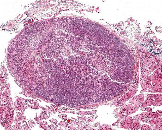 NIFTP Non-Invasive Follicular Thyroid Neoplasm with Papillary-like Nuclear Features Completely