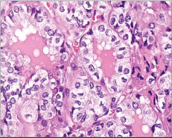 No aggressive histology Oncogene-driven (RAS and RASlike gene mutations) Previously known as