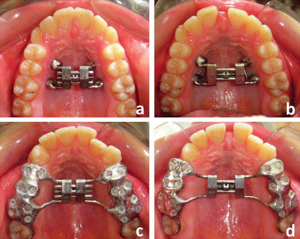 MINISCREW-SUPPORTED RME IN ADOLESCENTS 703 Figure 1. Pre- (a) and postexpansion (b) occlusal photographs of a patient from the miniscrew-supported (bone-borne) RME group.