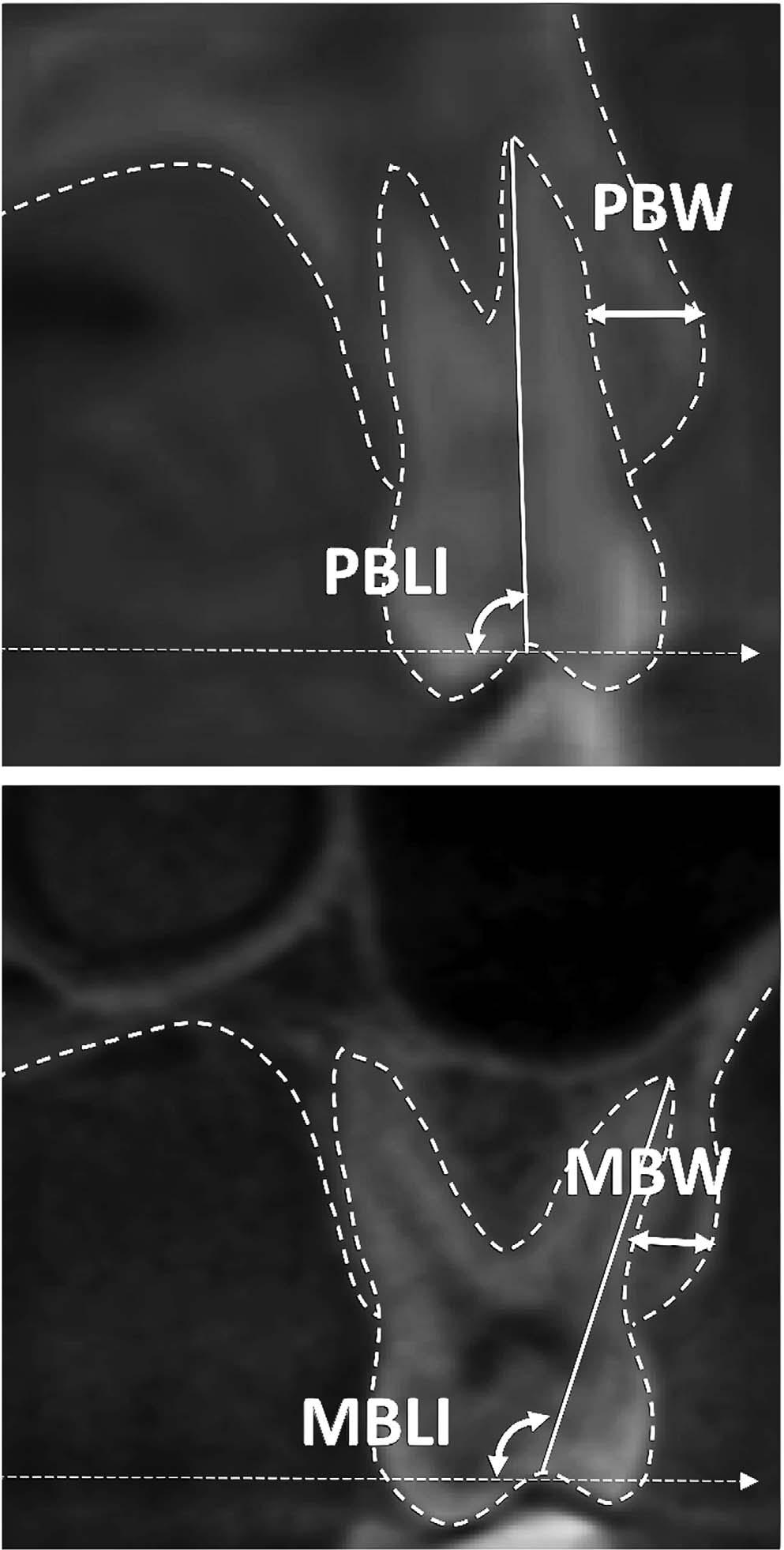 MINISCREW-SUPPORTED RME IN ADOLESCENTS 705 Figure 4. Buccal width measurements obtained at the level of the maxillary first premolar bifurcation (PBW) and maxillary first molar trifurcation (MBW).
