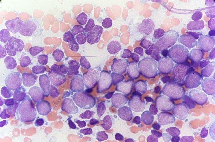 Case 83 Woodham Therapy-related myeloid neoplasm with features of MPAL, B/myeloid 69M, h/o neuroendocrine carcinoma, s/p chemotherapy/radiation, circulating blasts