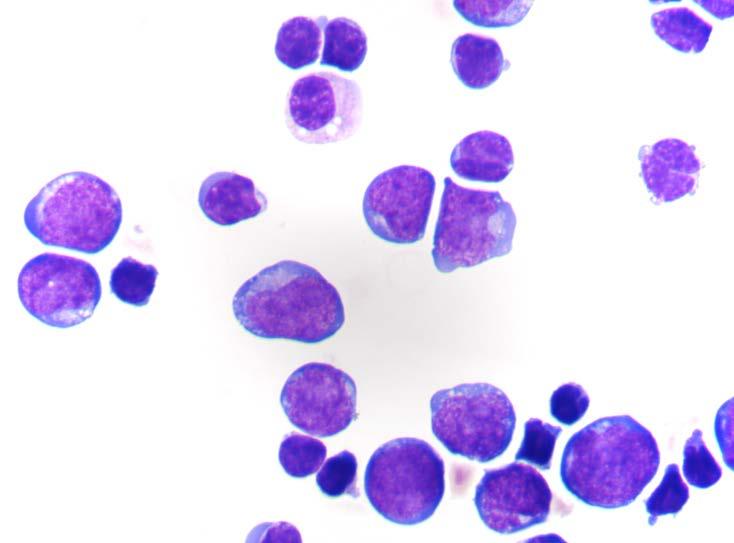 Miscellanea Case 265 Yuan B-ALL/LBL, NOS (with MYC rearrangement) 56F, numerous blasts in PB, generalized lymphadenopathy, splenomegaly