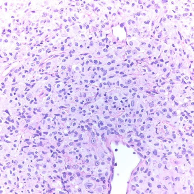 Genetic abnormalities indicating residual disease or prior underlying neoplasm Case 69 Devins AML with mutated NPM1 68M, circulating blasts, anemia and thrombocytopenia NPM1, KIT, DNMT3A and TET2 at