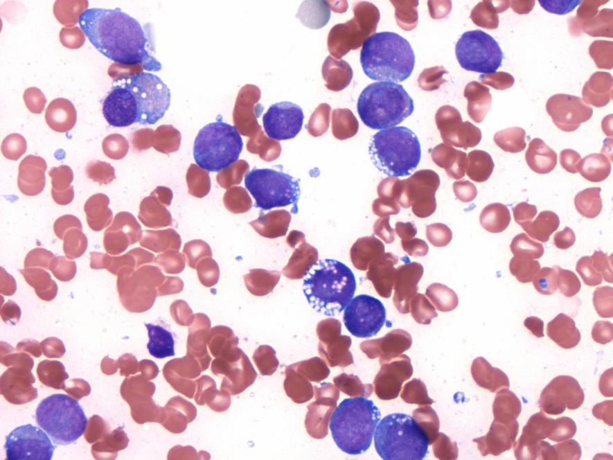 Clonal relationship, clonal evolution and disease heterogeneity Case 155 Crane Therapy related-aml 38F, h/o breast carcinoma, treated with chemotherapy and radiation, BRCA1+, t-aml, s/p SCT,