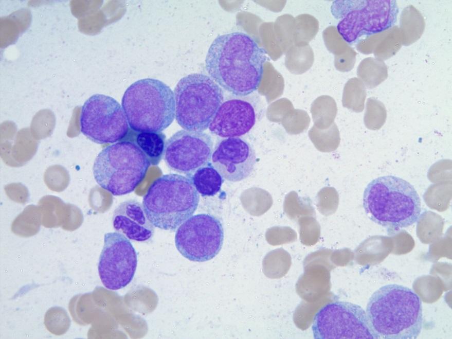 Case 144 Bhattacharyya Acute myeloid leukemia with mutated NPM1 Therapeutic