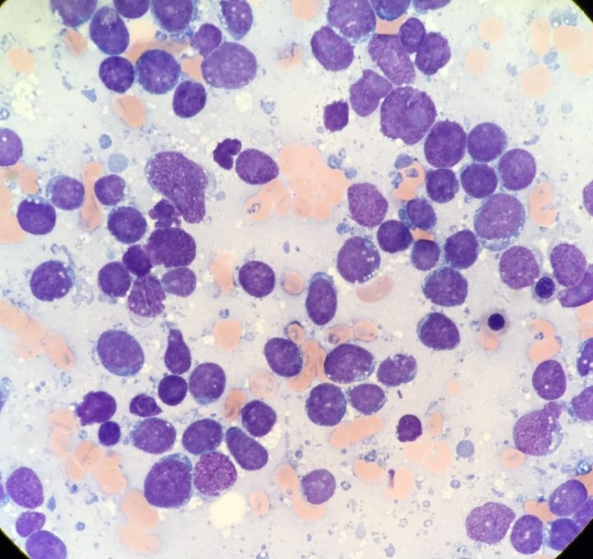 Case 243 Yuksel MPAL, B/myeloid, NOS 68M, cytopenias, hepatosplenomegaly Diagnostic dilemma IHC: positive CD34, MPO, CD20, CD79a, PAX5, TDT, BOB1 and weak CD19 FC BM: positive