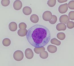 De novo AML and therapy-related lymphoid neoplasms with variant or novel KMT2A rearrangements Case 136