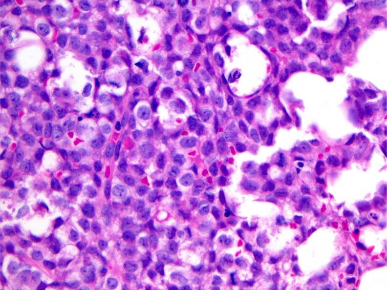 Acute myeloid leukemias with genetic abnormalities typically seen in