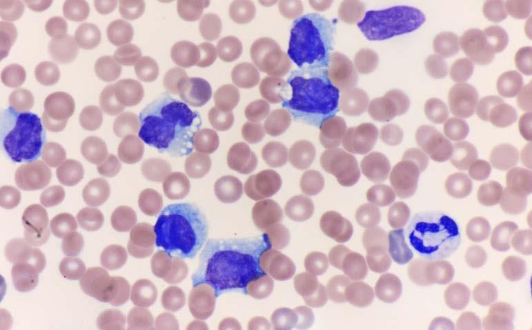 Acute myeloid leukemias with genetic abnormalities typically seen in lymphoid neoplasms Case 224 Teruya Feldstein AML, NOS (acute monocytic leukemia, with ALK rearrangement) 58M, leukocytosis with