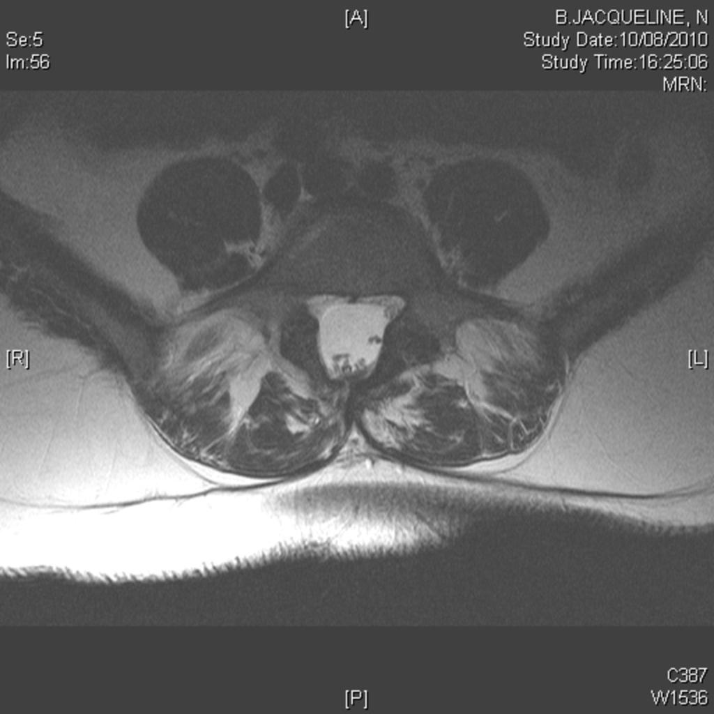 Fig. 0: Figure 1c Patient with dysraphism of the lumbosacral spine, presenting as back pain.