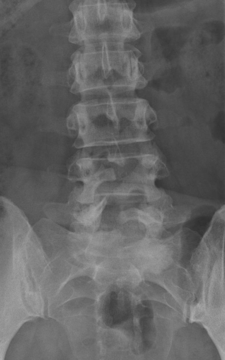 Fig. 0: Figure 1d Patient with dysraphism of the lumbosacral spine, presenting as back pain.