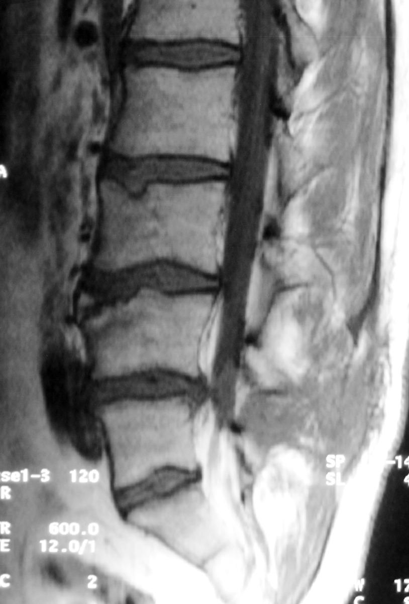 Fig. 0: Figure 2a 29 year old man with a non-united ring apophysis. Premature degenerative change. Damage to the ring apophysis can lead to an increased ap diameter of the spine.