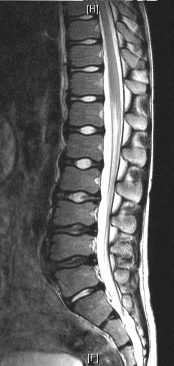 Fig. 0: Figure 3 7 year old boy with premature degeneration of the lower lumbar spine.