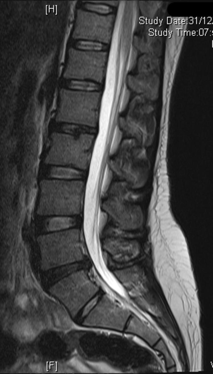 Fig. 0: Figure 4a 24 year old female with low back pain and disc disease.
