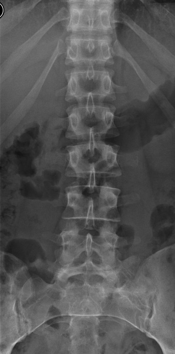 Fig. 0: Figure 4b 24 year old female with low back pain and disc disease.