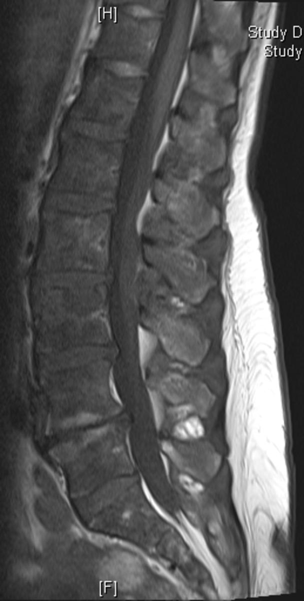 Fig. 0: Figure 6b: 57 year old patient with backpain and known hyperparathyroidism.