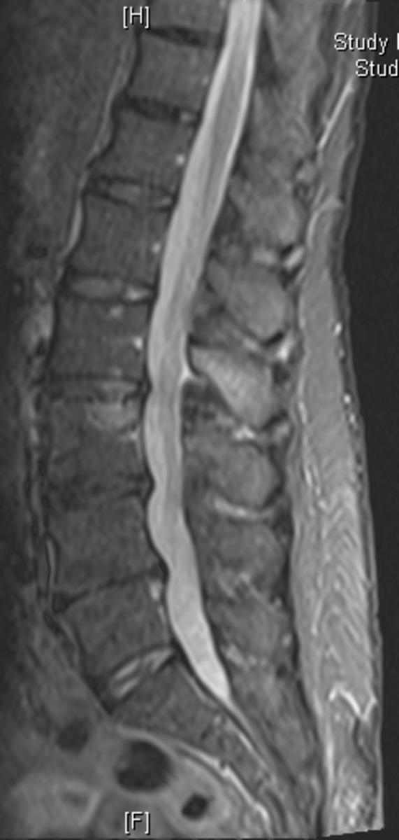 Fig. 0: Figure 6c: 57 year old patient with backpain and known hyperparathyroidism.