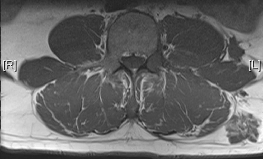 Fig. 0: Figure 8c: Abnormal haemangioma with low signal in T1w sequences and soft tissue extension as seen