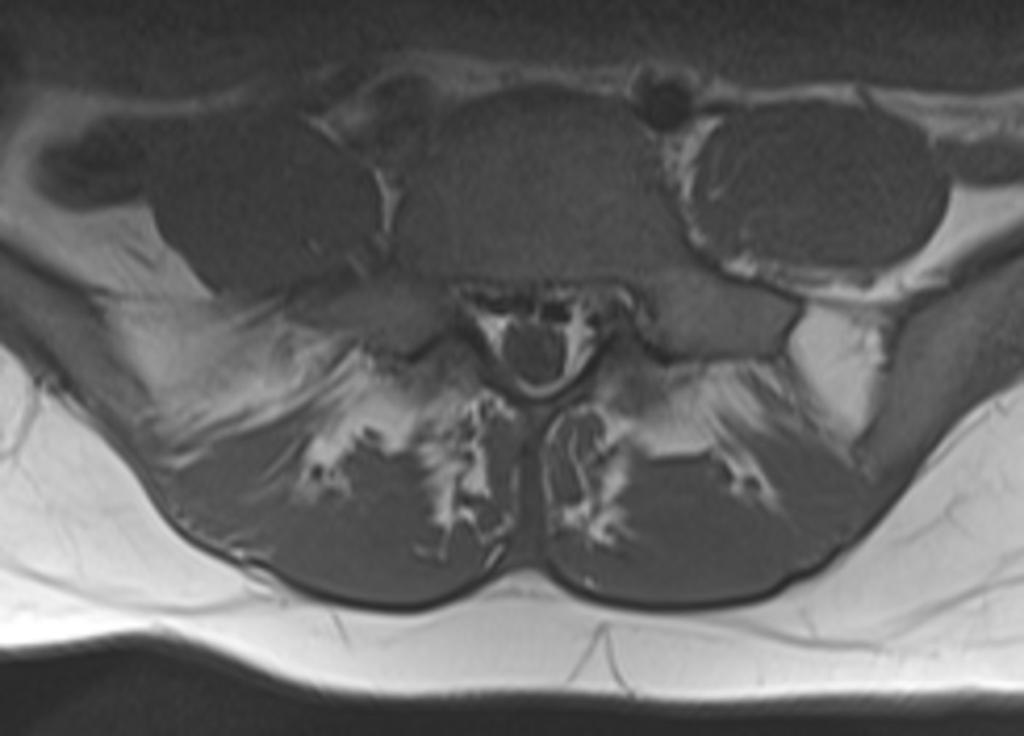 Fig. 0: Figure 11a: Abnormally prominent venous plexus in a pregnant female.