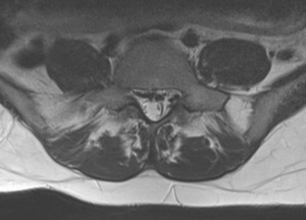 Fig. 0: Figure 11b: Abnormally prominent venous plexus in a pregnant female.