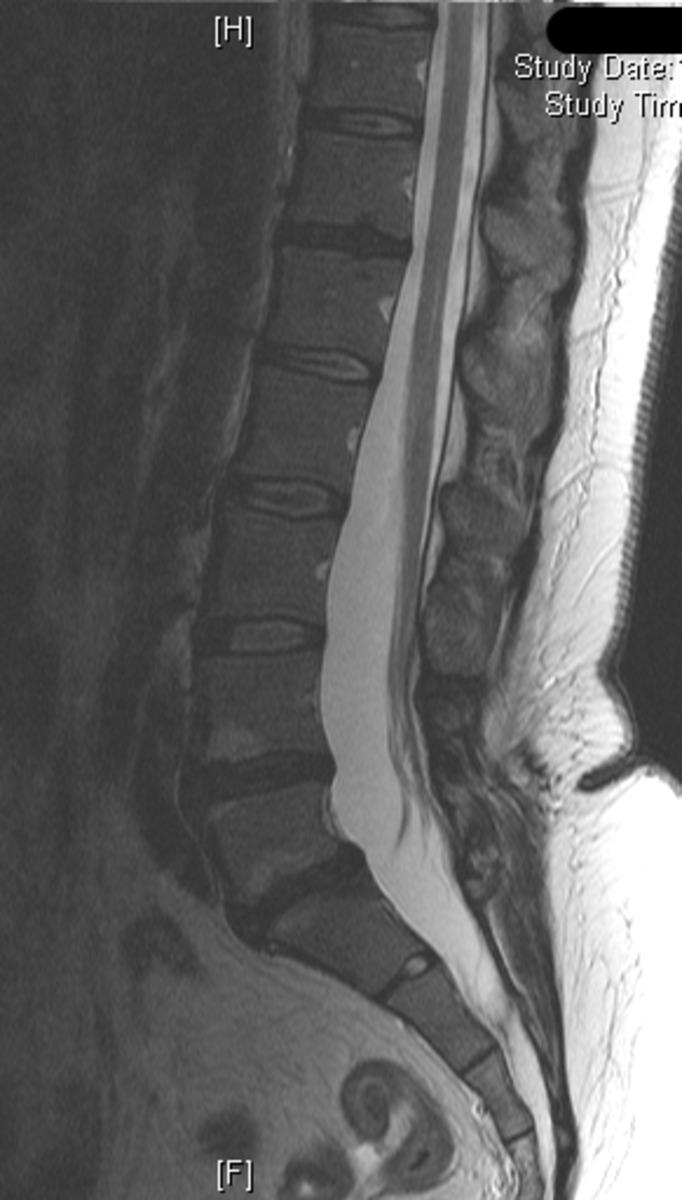 Images for this section: Fig. 0: Figure 1a Patient with dysraphism of the lumbosacral spine, presenting as back pain.