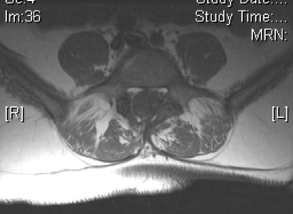 Fig. 0: Figure 1b Patient with dysraphism of the lumbosacral spine, presenting as back pain.