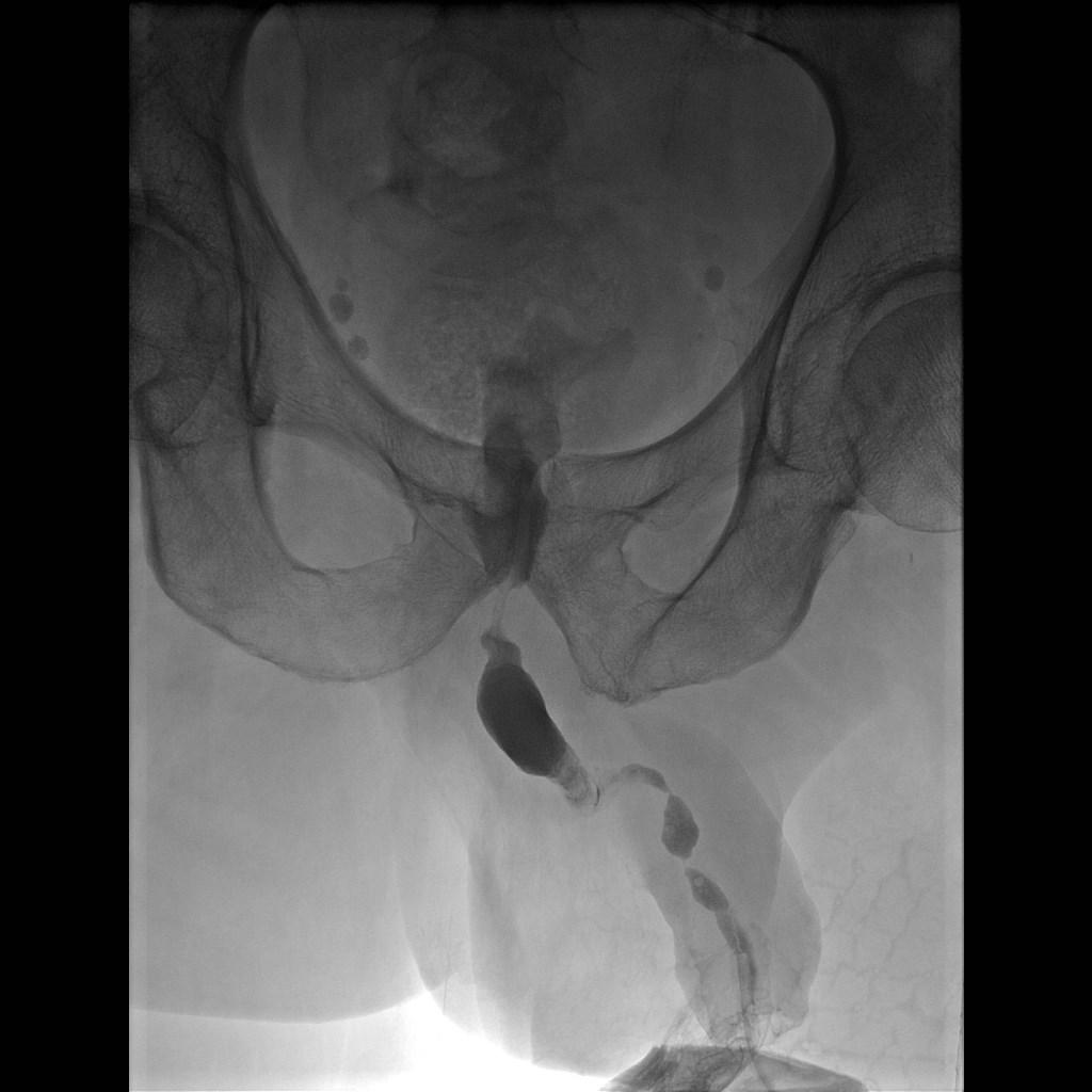 Management options for Panurethral Stricture?