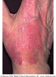 Irritant Contact Dermatitis Chronic exposure to soap and water causing subacute inflammation Patients vary in their ability to withstand exposure to irritants Poison Ivy-Oak-Sumac 70% or more