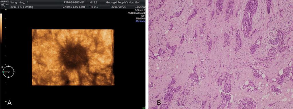 Figure 3. Sun-like symptom on coronal plane of 3D ultrasound image and histopathological pattern.