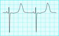 Intervals PR and QRS durations are relatively short from birth to age 1 and gradually lengthen during childhood; corrected QT (QTc) should be calculated on all pediatric