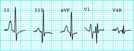Atrial Enlargement RAE is diagnosed in the presence of a peaked tall P wave in II In the first 6 months, the P wave must be >3 mm to be pathologic; then >2 mm is abn