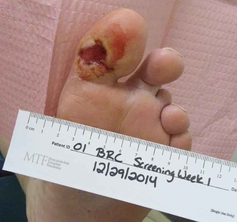 Case 3 A 61 year-old morbidly obese male with past medical history of Type two diabetes mellitus with peripheral neuropathy presented with chronic, non-healing left hallux ulceration present for 36