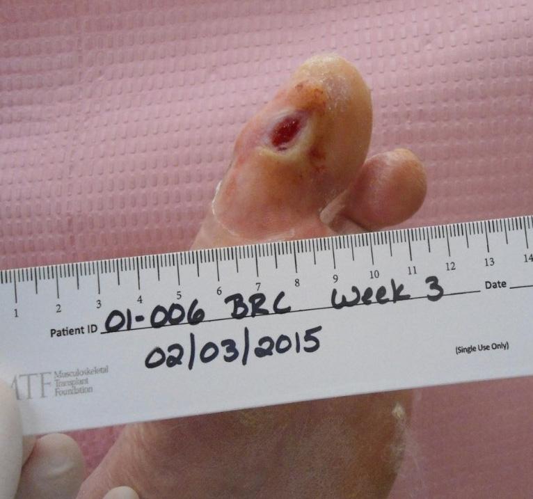 10cm Figure 8e: Week 2 After 2 weeks of treatment with