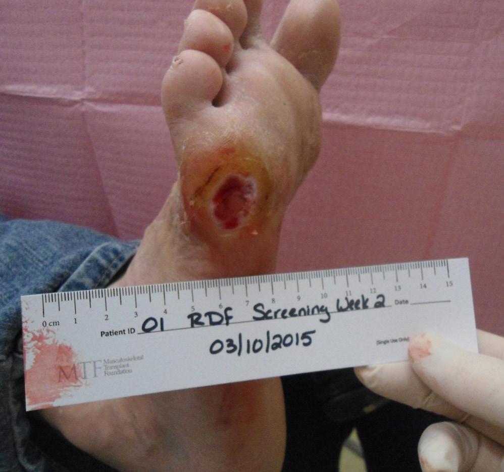 hospital wound healing center without success for over a month. The patient has a history of recurring forefoot ulcers. He had been using gauze and antibiotic cream daily with an offloading shoe.