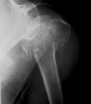 Surgical Technique Proximal Humeral Fracture Repair Fractures of the proximal humerus are a common fracture type.