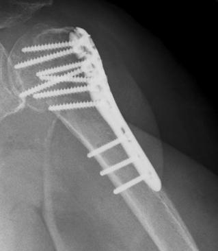 While some fractures of the proximal humerus are treated nonoperatively, many need operative treatment, including displaced two-, threeand four-part fractures.