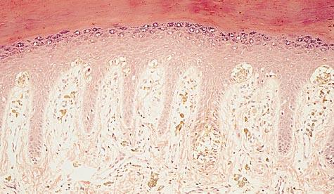Fibrillar pigmentation is arranged in a meshlike manner, producing a characteristic feature.