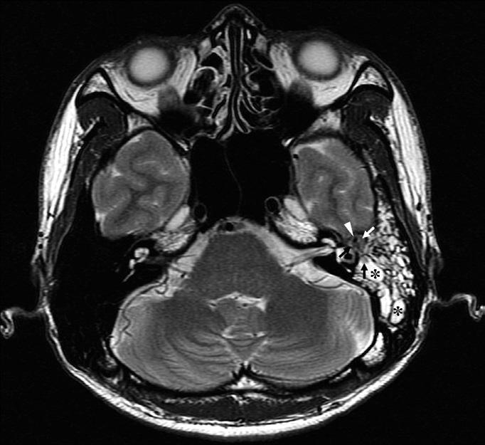 (arrows), isointense to the gray matter, filling the entire middle ear cavity, aditus ad antrum, and a portion of the mastoid