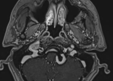 Case Presentation MRI brain with contrast: Enhancing tumor (red