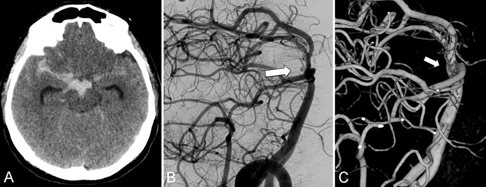 A. Chavent et al. Fig. 1. Case 1. A: Noncontrast axial CT scan showing a Fisher Grade 3 diffuse SAH. B: Angiogram obtained 8 days after SAH showing an aneurysm of 1.