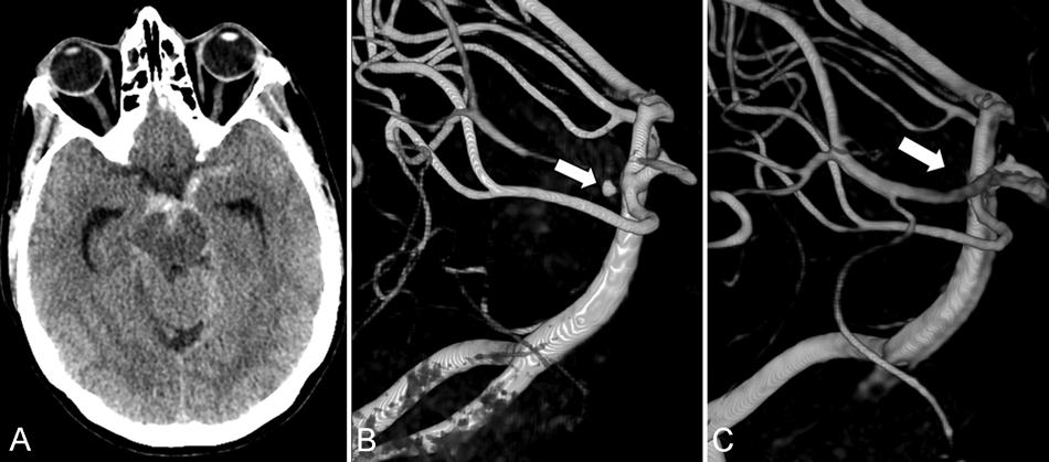 a slow-filling aneurysm of 1.5 mm arising immediately after the origin of an anteromedial mesencephalic perforator artery of the interpeduncular fossa (Fig. 2B). chosen as the treatment strategy.