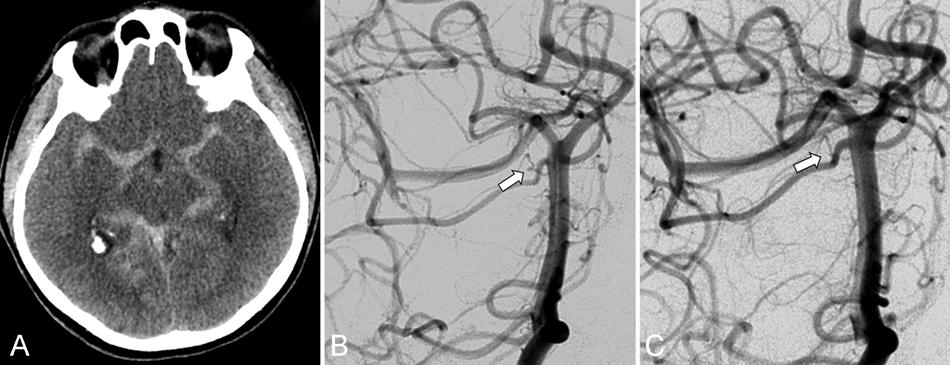 Spontaneous resolution of perforator aneurysms Fig. 3. Case 3. A: Noncontrast axial CT scan showing diffuse SAH.