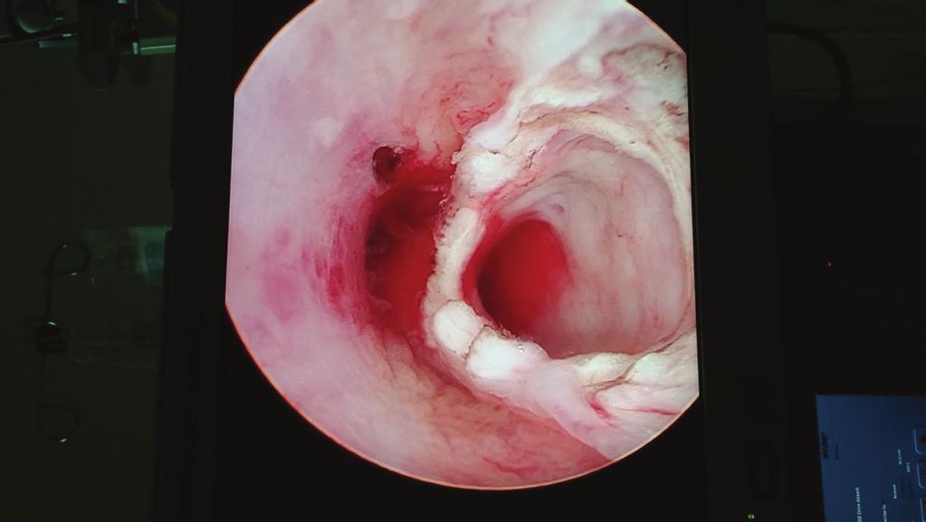 Case Reports in Urology 3 Figure 3: Urethroscopy following transurethral unroofing between the syringocele and the bulbar urethra.