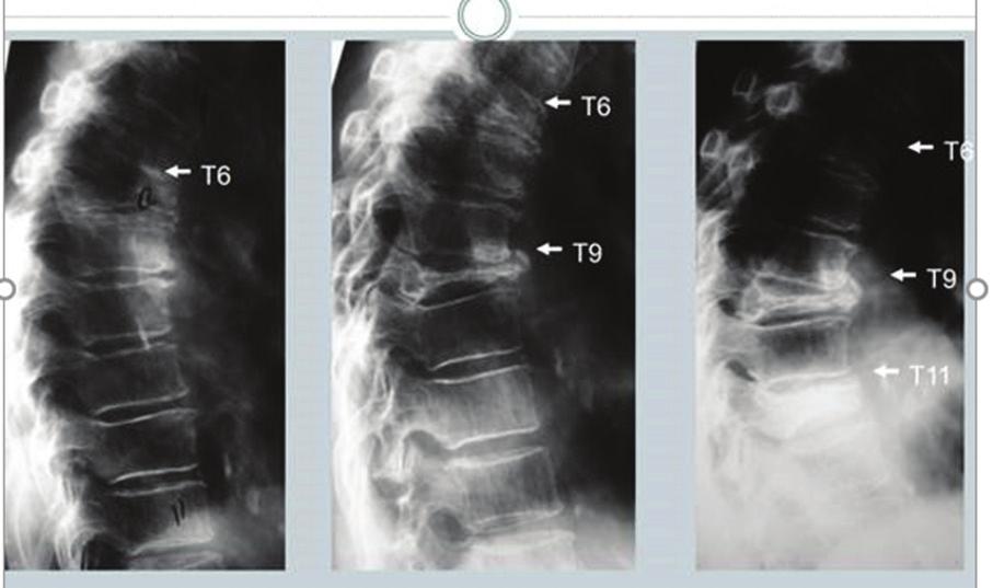 ! AS A CLINICIAN OR RADIOLOGIST Be alert to the signs of vertebral fractures in your patients and ensure that any vertebral fractures are spotted and accurately reported.