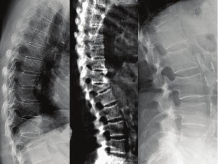 TIPS FOR RADIOLOGISTS Recognize the importance of the identification of vertebral fractures using radiography, DXA-based VFA and other spinal imaging techniques Report all osteoporotic fractures as