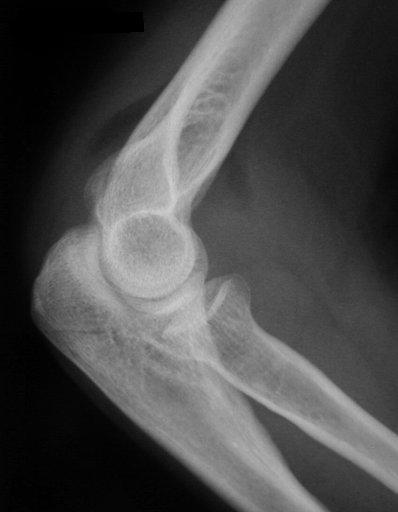 Investigations Plain radiography Most radial head fractures can be diagnosed with standard lateral and (supinated) AP views.