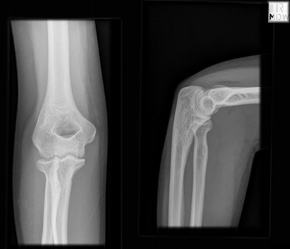 Appendix 1 Occult type I radial head fracture: Radiographs of a 26 year old woman who sustained a fall onto her right