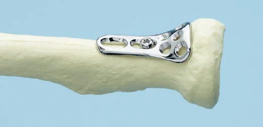 one of the elongated Combi holes. Note: The plates are precontoured to fit the anatomy of the radial head.