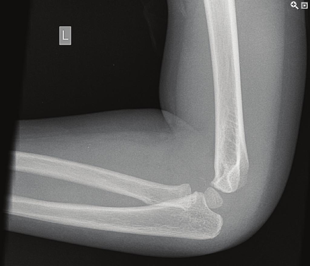 2 Figure 1: Lateral radiograph of three-year-old boy showing olecranon fracture. Case Reports in Surgery Figure 3: Repeat lateral radiograph of the same elbow twelve days later.