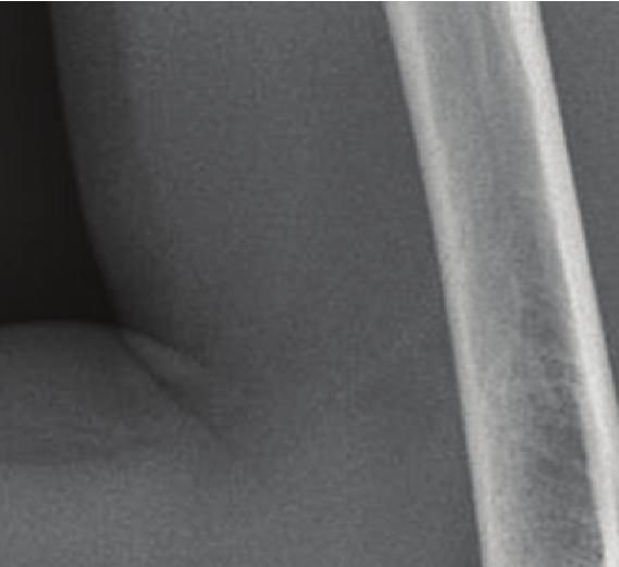 Posterior or postero-lateral dislocation of the radial head. Fracture of the ulna with posterior angulation. Lateralorantero-lateraldislocationoftheradialhead.Fractureofulnametaphysis.